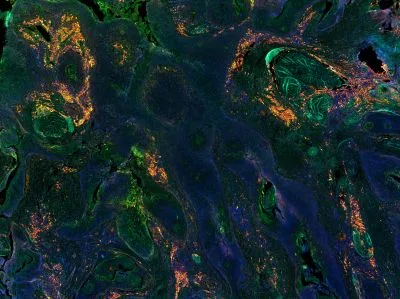 Advancing Precision Therapy for Urologic Tumors: Integrating Immunotherapy and Organoid Models