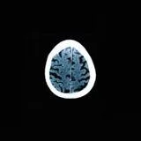 Epigenetic Pathways and Human iPSC-Derived Models: Towards Next-Generation Alzheimer’s Disease Therapies