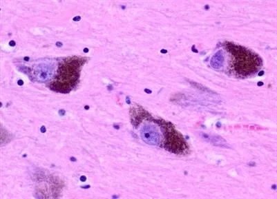 Neuromelanin and Iron in Parkinson's Disease: Mechanisms, Heterogeneity, Biomarkers, and Progression