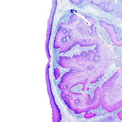 Innovative Approaches in Glioma Therapy: Exploring New Therapeutic Frontiers- Volume III