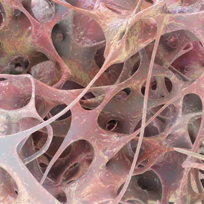Diagnosis and Treatment of Osteoporotic Fractures: Advances, Challenges, and Future Perspectives, Volume II