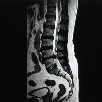 Understanding spinal epidural lipomatosis: Clinical challenges and emerging insights