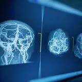 Integrating CSF flow and glymphatic system insights into neurovascular disorders: From imaging to interventions