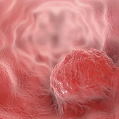 Organ Preservation in Rectal & Esophageal Cancer: Radiomics, Molecular Predictors, and Salvage Surgery