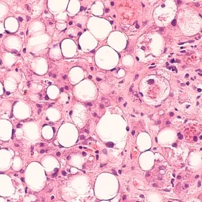 Immune Stratification for Precision Care in Decompensated Cirrhosis and ACLF