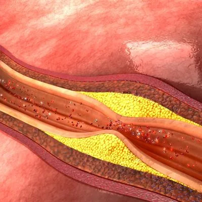 Decoding Intercellular Interactions In Atherosclerosis Development